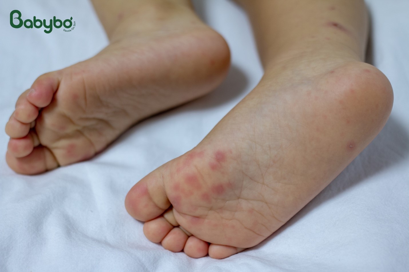Dấu hiệu tay chân miệng thường xuất hiện ở lòng bàn tay, bàn chân với các nốt đỏ li ti hoặc phỏng nước nhỏ.